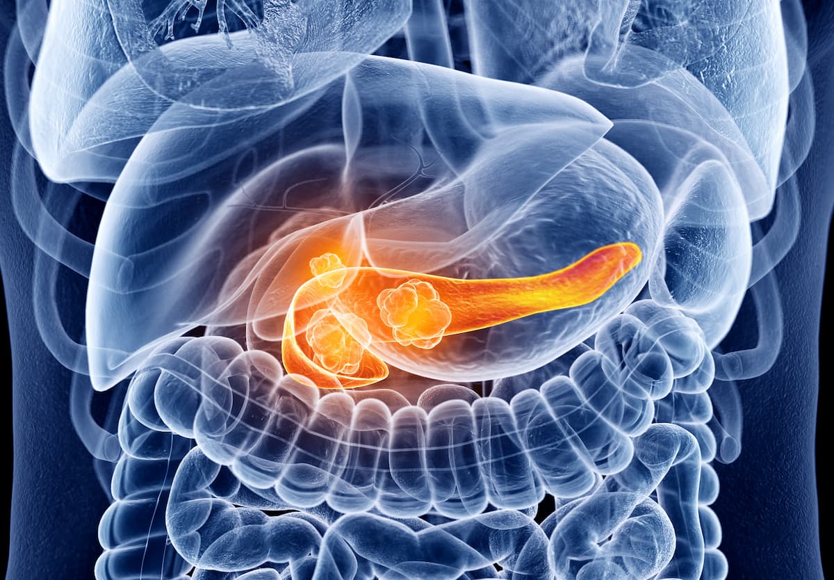 Anatomical illustration of a tumor-bearing pancreas highlighted in orange against surrounding abdominal organs.